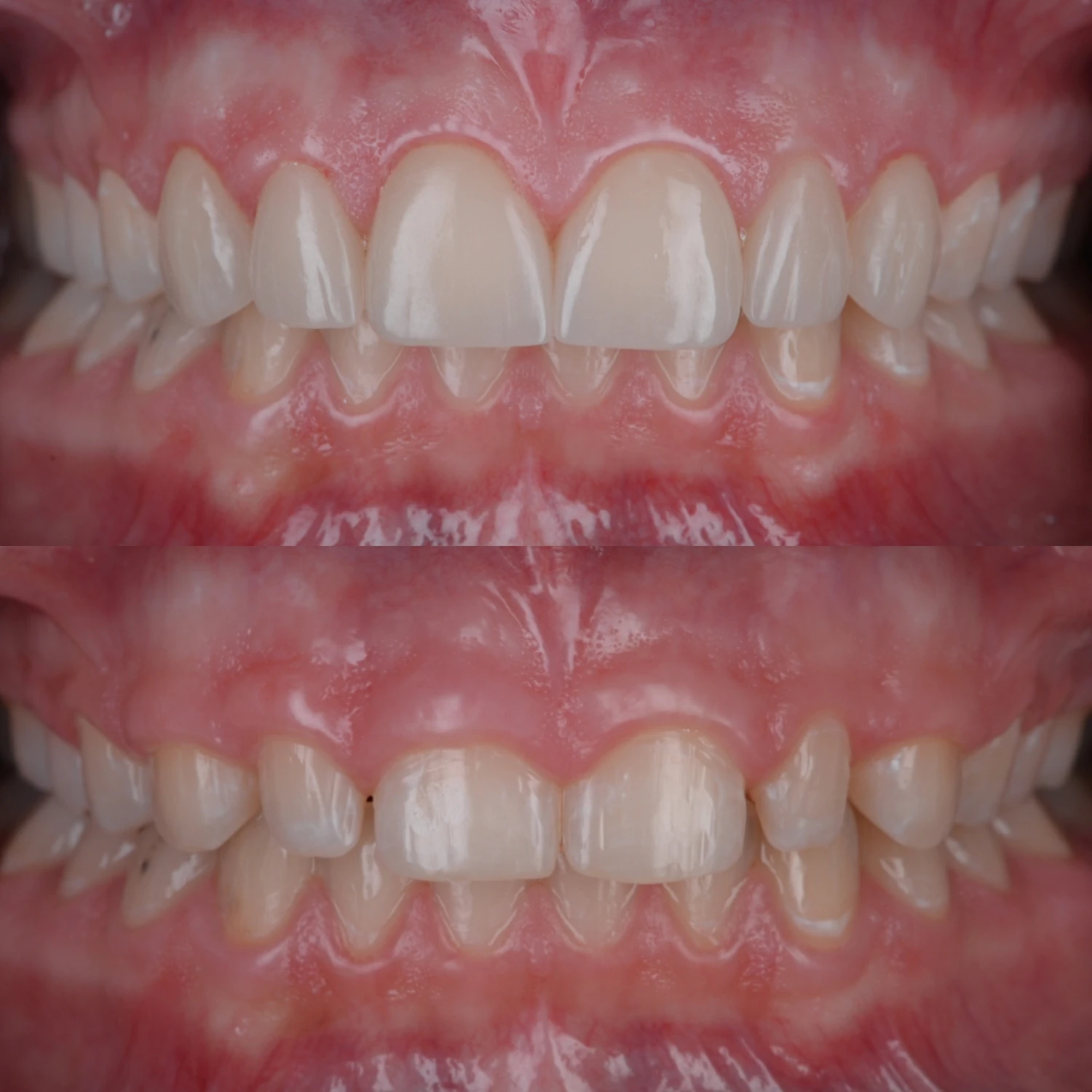 dupa (sus) _ inainte (jos) caz clinic 20